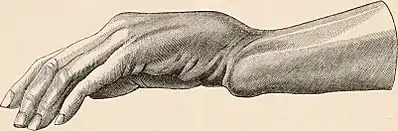 Dorsal displacement of carpal bones seen in dorsally angulated distal radius fracture, creating a fork-like appearance