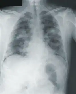 Chest x-ray of pneumonic plague showing bilateral, diffuse interstitial pleural infiltrates, and accompanying consolidation. As well as, what appeared to be marked, mediastinal adenopathy.