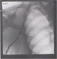 After treatment with catheter-directed thrombolysis, blood flow in the axillary and subclavian vein were significantly improved. Afterwards, a first rib resection provided thoracic outlet decompression to reduce the risk of recurrent DVT and the risk of sequelae from thoracic outlet compression.