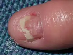 Acitretin nail thinning