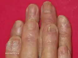 Acitretin nail thinning