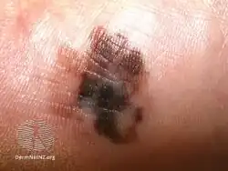 Acral lentiginous melanoma