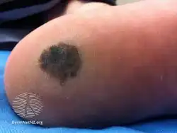 Acral lentiginous melanoma