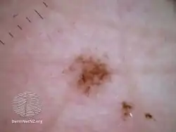 Acral lentiginous melanoma dermoscopy