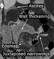 CT scan of a small bowel volvulus. It shows two juxtaposed segments of narrowing, which is the spot of mesentery rotation. The other signs indicate strangulation.