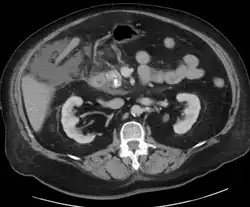 Calcified pancreatic duct stones with some free intra-abdominal fluid