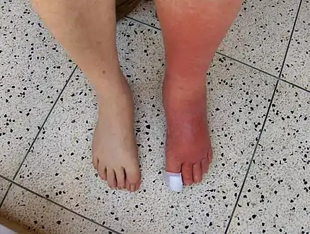 Cellulitis rash