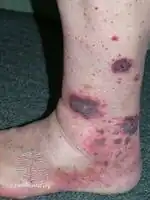 Cutaneous vasculitis