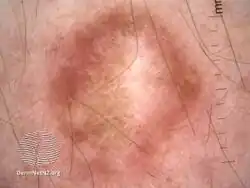 Dermatofibroma dermatoscopy