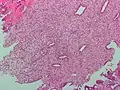 Micrograph of decidualized endometrium due to exogenous progesterone. H&E stain.