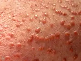 Eruptive xanthoma