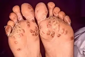 Keratoderma blennorrhagicum due to reactive arthritis