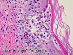 Eosinophilic folliculitis/pathology