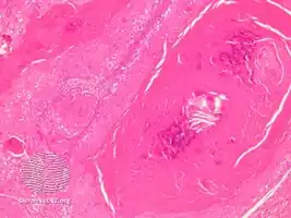 pathology-Proliferating trichilemmal cyst