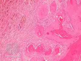 pathology-Proliferating trichilemmal cyst