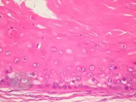 pathology-Proliferating trichilemmal cyst