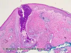 Eosinophilic folliculitis/pathology