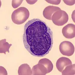 Sézary cell: pleomorphic abnormal T cell with the characteristic cerebriform nuclei (Peripheral blood - MGG stain).