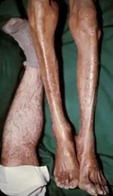 Legs of a 62 year old white person with darkening skin due to iron overload. The leg to the left is a normal individual.