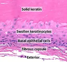 Histopathology of a trichilemmal cyst, from internal (top) to external (bottom):- Solid eosinophilic-staining keratin.- Swollen pale keratinocytes, which increase in height closer to the interior.- Small, cuboidal, dark-staining basal epithelial cells in a palisade arrangement, with no distinct intercellular bridging.- Fibrous capsule.There is no granular cell layer (in contrast to an epidermoid cyst).