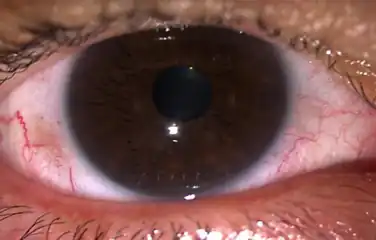 Adenoviral keratoconjunctivitis