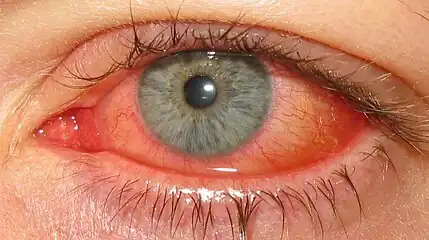 Adenoviral keratoconjunctivitis