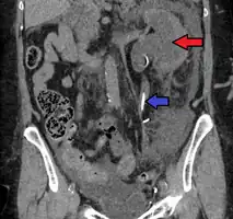 Left sided hydronephrosis, coronal view. Stent is also present.