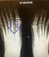 Lisfranc dislocation of the left foot due to lisfranc ligament rupture as seen on bilateral weight bearing radiographs.