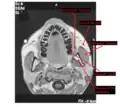 An MRI of head with captions for masseter muscle and other structures around it