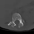 CT scan axial view: expansile osteoblastoma  spine