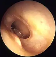 Otitis media chronica mesotympanalis