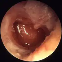 Chronic otitis media (otitis media chronica mesotympanalis)