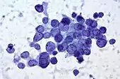 Papillary thyroid cancer, fine-needle aspiration biopsy.