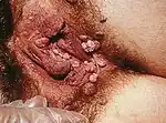 Severe case of external genital warts on a female