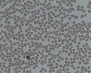 A picture of the blood under a microscope showing thrombocytopenia