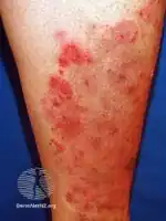 Tinea incognita