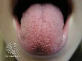 Transient lingual papillitis