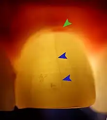 Transillumination demonstrating fracture