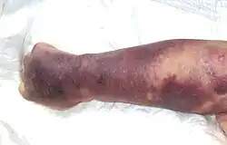 Right upper limb with purpura caused by thrombocytopenia in person with septic shock