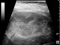 Figure 26. Acute pyelonephritis with increased cortical echogenicity and blurred delineation of the upper pole.