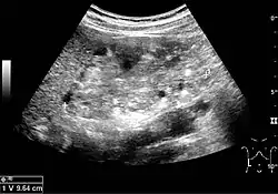 Renal ultrasonography of a person with tuberous sclerosis and multiple angiomyolipomas in the kidney: Measurement of kidney length on the US image is illustrated by ‘+’ and a dashed line.