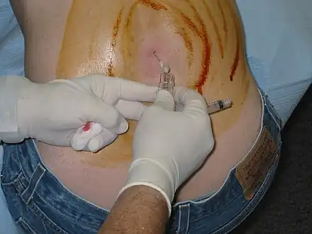 Lumbar puncture in a sitting position. The reddish-brown swirls on individuals back are tincture of iodine (an antiseptic).