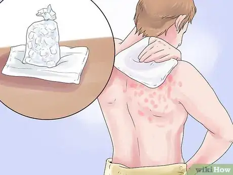 Image titled Get Rid of a Skin Rash Caused by Antibiotic Allergy Step 8