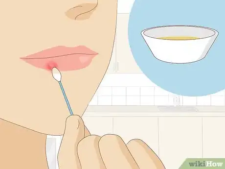 Image titled Treat Cold Sores with Essential Oils Step 6