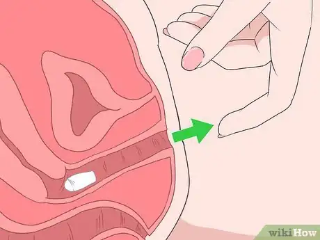 Image titled Insert Progesterone Suppositories Without an Applicator Step 7