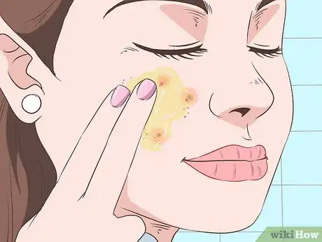 Image titled Quickly Heal Open Sores on Your Face Step 3