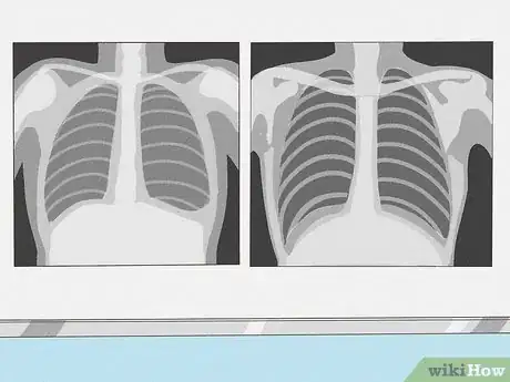 Image titled Know if a Chest X Ray Film Is Rotated Step 8